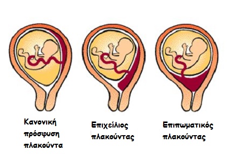 placenta previa 3